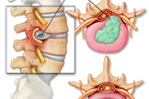 Disc Herniations
